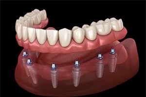 example of implant dentures in Carlisle
