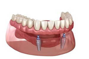 Illustration of Snap-On denture for lower dental arch