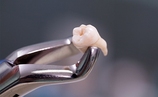 Metal clasp holding extracted tooth