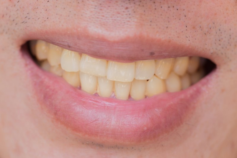 A closeup of a smile with yellow teeth